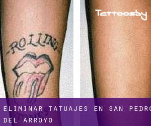 Eliminar tatuajes en San Pedro del Arroyo