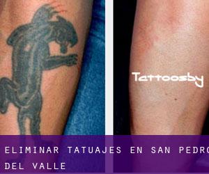 Eliminar tatuajes en San Pedro del Valle