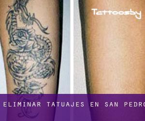 Eliminar tatuajes en San Pedro