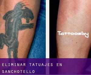 Eliminar tatuajes en Sanchotello