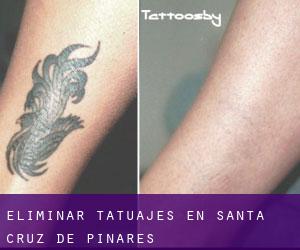 Eliminar tatuajes en Santa Cruz de Pinares