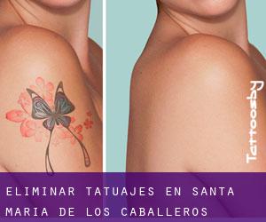 Eliminar tatuajes en Santa María de los Caballeros