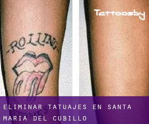 Eliminar tatuajes en Santa María del Cubillo