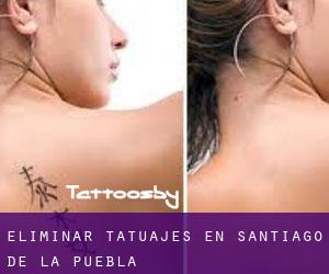 Eliminar tatuajes en Santiago de la Puebla