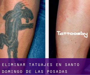 Eliminar tatuajes en Santo Domingo de las Posadas