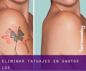 Eliminar tatuajes en Santos (Los)