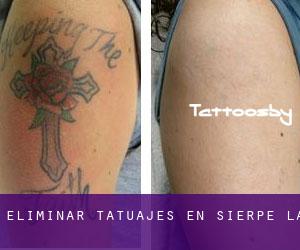 Eliminar tatuajes en Sierpe (La)