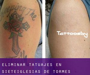 Eliminar tatuajes en Sieteiglesias de Tormes