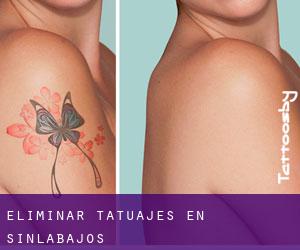 Eliminar tatuajes en Sinlabajos