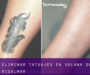 Eliminar tatuajes en Solana de Rioalmar