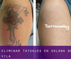 Eliminar tatuajes en Solana de Ávila