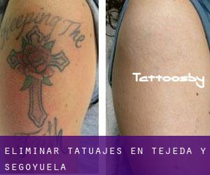 Eliminar tatuajes en Tejeda y Segoyuela