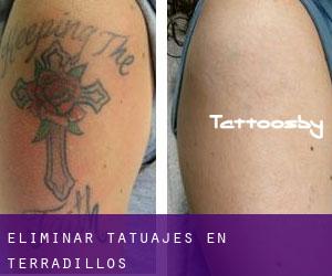 Eliminar tatuajes en Terradillos