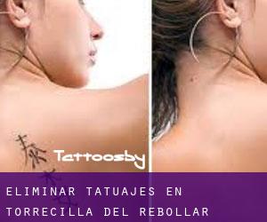 Eliminar tatuajes en Torrecilla del Rebollar