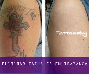 Eliminar tatuajes en Trabanca