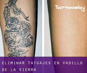 Eliminar tatuajes en Vadillo de la Sierra