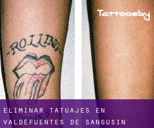 Eliminar tatuajes en Valdefuentes de Sangusín