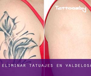 Eliminar tatuajes en Valdelosa