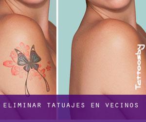 Eliminar tatuajes en Vecinos