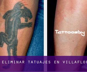 Eliminar tatuajes en Villaflor