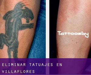 Eliminar tatuajes en Villaflores