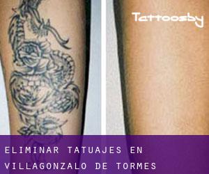 Eliminar tatuajes en Villagonzalo de Tormes