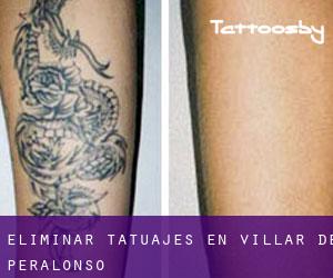 Eliminar tatuajes en Villar de Peralonso