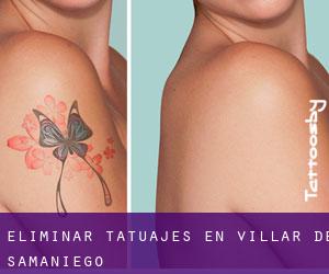 Eliminar tatuajes en Villar de Samaniego