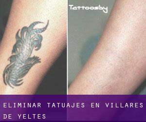 Eliminar tatuajes en Villares de Yeltes