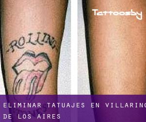 Eliminar tatuajes en Villarino de los Aires