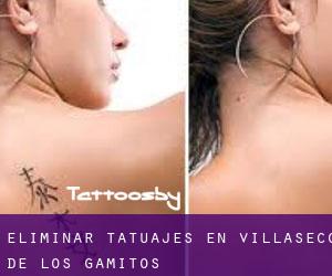 Eliminar tatuajes en Villaseco de los Gamitos