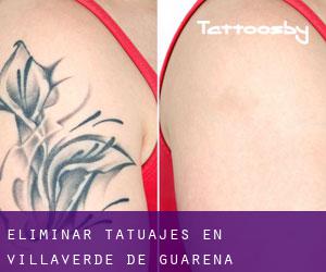 Eliminar tatuajes en Villaverde de Guareña