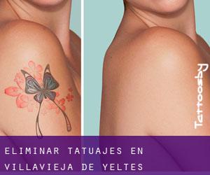 Eliminar tatuajes en Villavieja de Yeltes