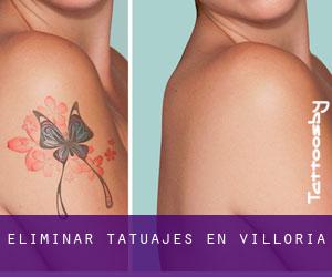 Eliminar tatuajes en Villoría