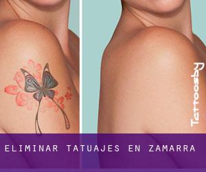 Eliminar tatuajes en Zamarra